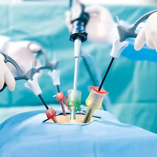 Laparoscopic surgery in progress through keyhole ports